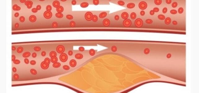 5 Cara Menurunkan Kolesterol Secara Alamiah